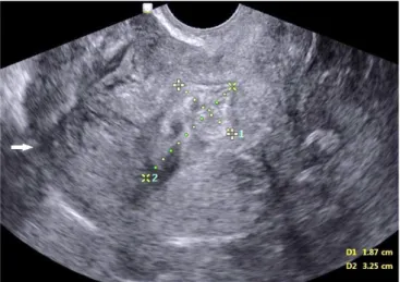 Fig. 2. Massive hemoperitoneum in the pelvic cavity at first sight of  diagnostic laparoscopy.