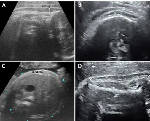 Table 2. Postpartum Outcomes in the SCTT Group and Non-SCTT Group Outcomes SCTT (n=46) Non-SCTT (n=810) P -value Birth weight (g) 3,717 (2,480­5,265) 3,140 (2,425­4,100) <0.001