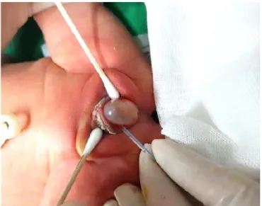 Fig. 1. A cystic mass that bulges between labia minora (case 1).