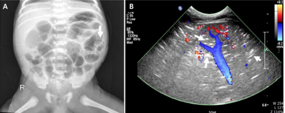 Fig. 3. Intraoperative findings were consistent with necrotizing entero- entero-colitis involving extensive areas of jejunum, ileum, and colon.