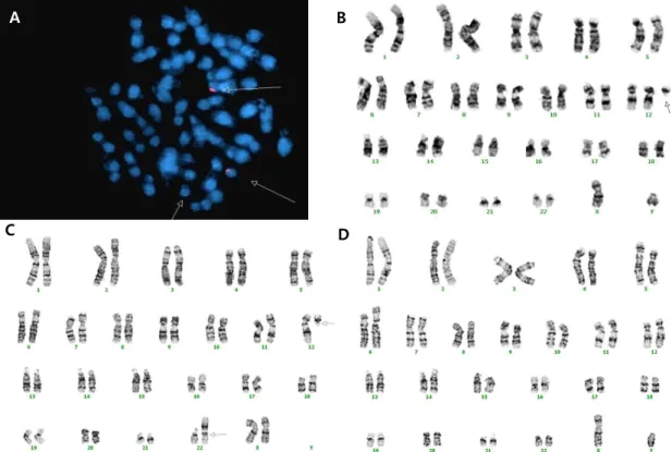 Fig. 2. Chromosome analysis of the patient and his parents. (A) Fluorescence in situ hybridization of the patient using a  chromosome 21-specific probe
