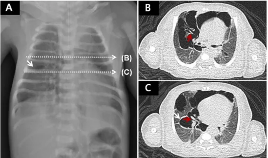 Fig. 2. Chest CT images (B, C) with correlation of the infantogram (A). White arrows (A, C) indicate RML  PIE which is visible at the infantogram