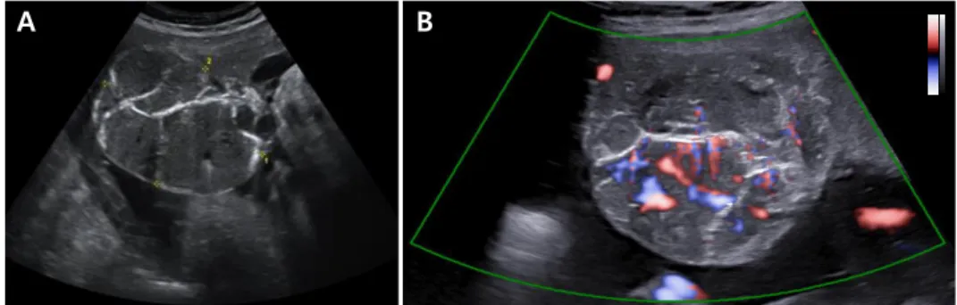 Fig. 1. (A) In ultrasonographic examination at 36 weeks of gestation, a 7×5 cm sized well circum- circum-scribed, round, heterogeneous mixed echoic mass along the fetal surface of the placenta was seen