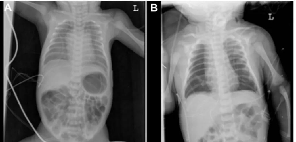 Fig. 1. Initial infantogram (A) and infantogram after tracheostomy (B). (A) Infantogram shows quite  good air content in both lungs, but with fine granular appearance