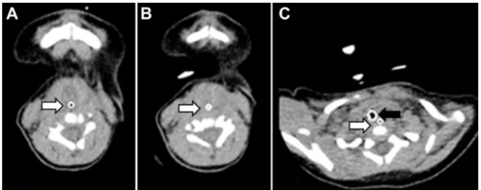 Fig. 2. Pharyngeal non-contrast computed tomography showed no visualization of trachea