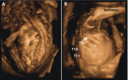 Fig. 2. Gross and computed tomography (CT) images of the infant. (A) The infant has a short neck, accessory nipples, and  abnormal rib cage on the left side