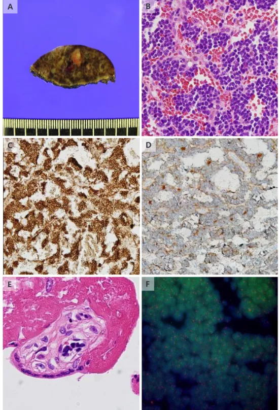 Fig. 2. (A) Nodular lesion and parenchymal hemorrhage in wedge resected liver. (B) Liver parenchyma is  filled with small round hyperchromatic cells