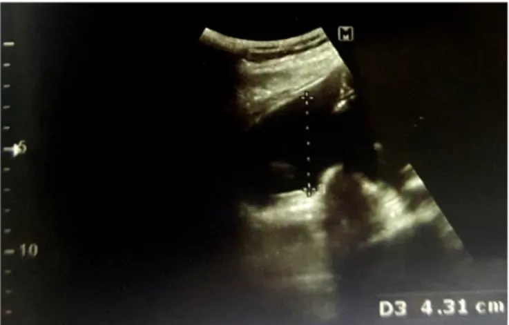 Fig. 3. Transvaginal ultrasonographic finding of the uterus after 1  week of operation (longitudinal section)