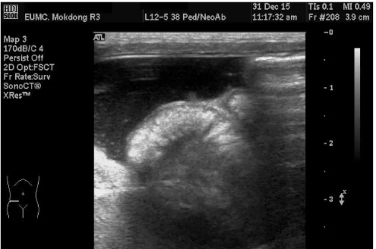 Fig. 4. In the ultrasonography, large amount of ascites and thickening  of the small bowel loop were seen.