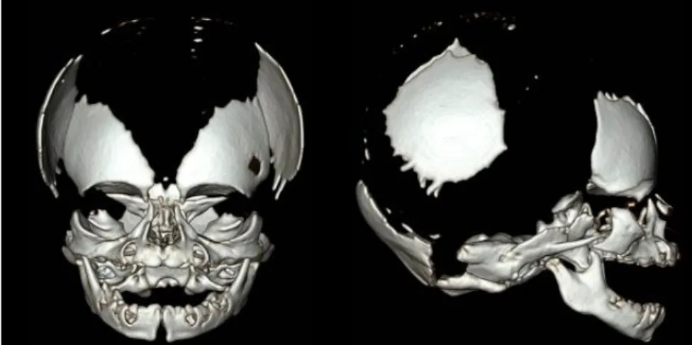 Fig. 1. Left lateral plain skull radiograph. (A) Poor ossification of frontal, temporal, parietal, and  occipital bones at birth
