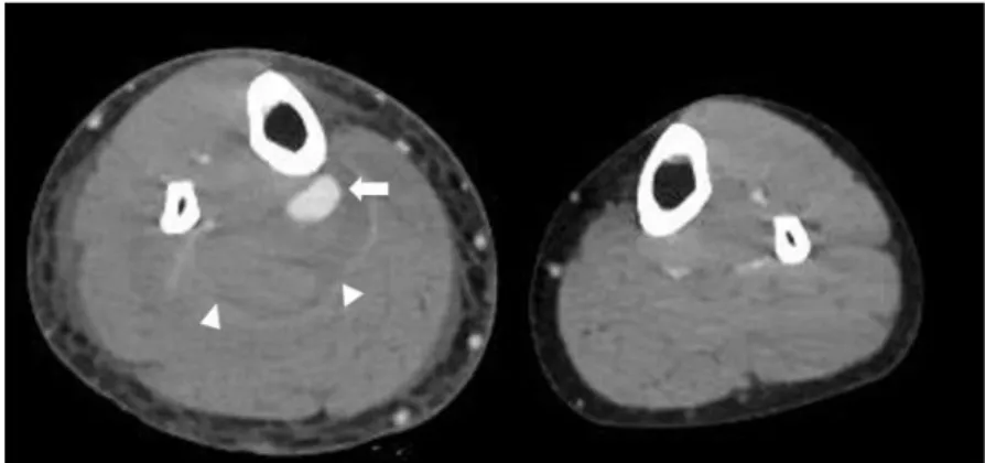 Fig. 1. Computed tomography venography revealed aneurysmal rupture of right  posterior tibial artery (arrow) with hematoma formation (arrowheads) without deep  vein thrombosis