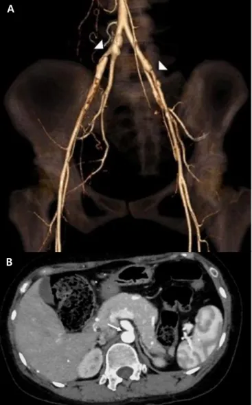 Fig. 3. Computed tomography (CT) angiography with three-dimen- three-dimen-sional reconstruction scan (A) showed luminal irregularity in common  iliac artery, external iliac artery (arrowheads)