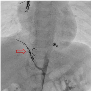 Fig. 6. Coil embolization. Previously embolized right internal mammary  artery was embolized with two additional Tornado coils (3 mm×2 cm)