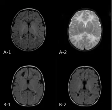 Fig. 1. Diffusion-weighted images of the patients. Diffusion-weight- Diffusion-weight-ed images of the 3 patients (A; patient 8, B; patient 9, C; patient 10)  of the group of positive rotavirus and abnormal MRI