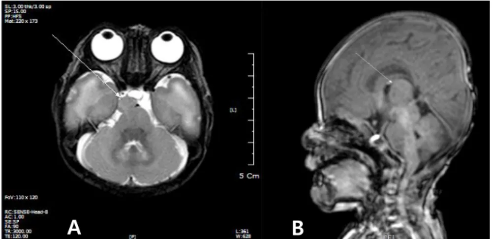 Fig. 3. Patient’s MRI T2W axial image (A), T1W sagittal image (B) showing a 1 cm in size, iso- iso-intensive round lesion at right suprasellar cistern, connected to right hypothalamus.