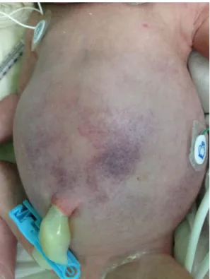 Fig. 2. At birth, the abdomen was distended, and the skin 