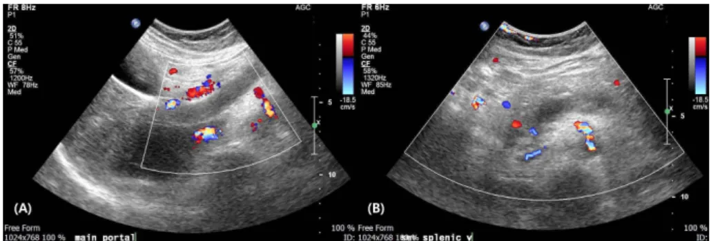 Fig. 2. Partial thrombotic occlusion, main portal vein (A), splenic vein (B) at 13 weeks of gestation.