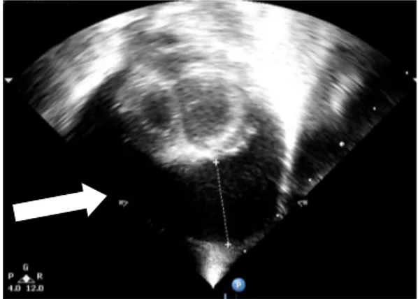Fig. 1. An echocardiogram of case 1. The arrow indicates  massive pericardial effusion with cardiac collapse.