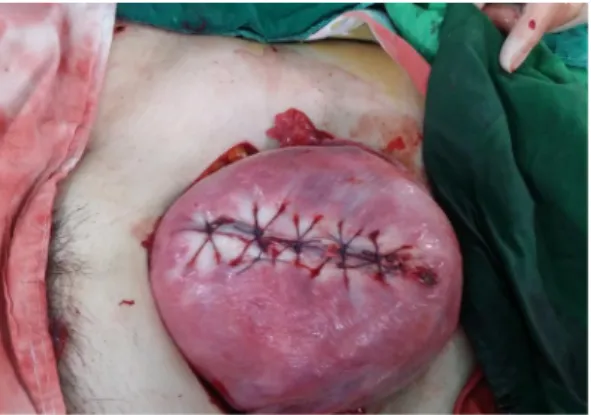 Fig. 2. The uterus was ruptured and split up about 10 cm at  anterior fundus.