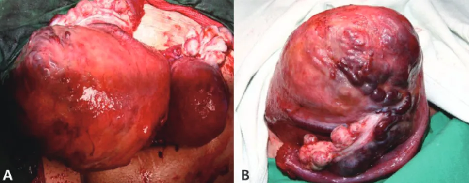 Fig. 3. (A) On cesarean section. Uterine didelphys is seen. There were many decidualized endo­