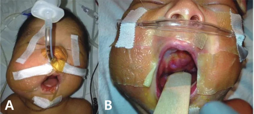 Fig. 1. Gross photographs taken prior to surgery. A mass at the right buccal area (A)  and a mass in the oral cavity with mouth was opened (B).