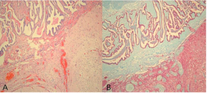 Fig. 3. Patient’s pathologic findings. The mass is composed of mature glial tissue and  choroid plexus-like area with papillary formation (A, Hematoxylin-and-eosin stain,  x100)