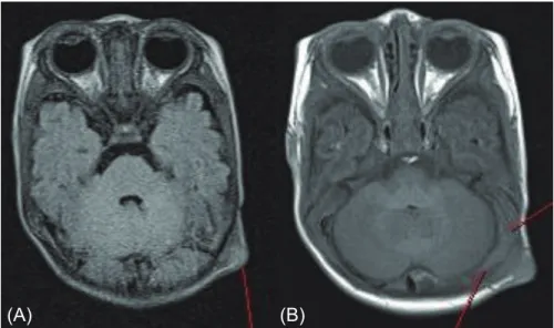 Fig. 1. (A) T2-weighted MRI of brain revealed 1.4×1.1 cm sized peripheral rim enhancing mass  at left occipital area