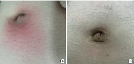 Fig. 1. (A) There is redness and swelling at periumbilical area due to cellulitis. (B) After antibiotics therapy, signs  of inflammation improved.