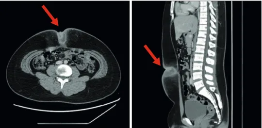 Fig. 2. Initial abdomen computed tomography shows fluid collection with enhancing wall and fat infiltration at  periumbilical soft tissue (red arrow); suggesting abscess (4.7×3.0 cm) with cellulitis.