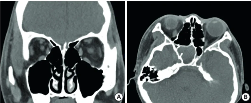 Fig. 1. (A) Coronal image of computed tomography revealed no evidence of inflammation in both maxillary and  ethmoidal sinus