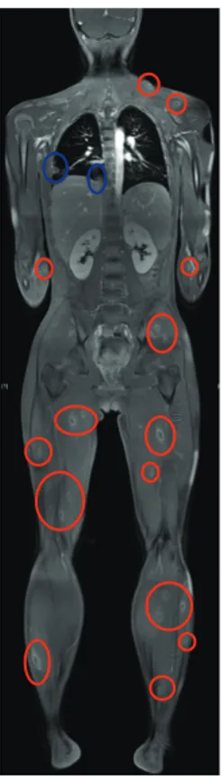 Fig. 1. Whole-body magnetic resonance imaging shows multiple peripheral rim-enhancing lesions in the shoulder,  upper limbs, and lower extremities (red circle)