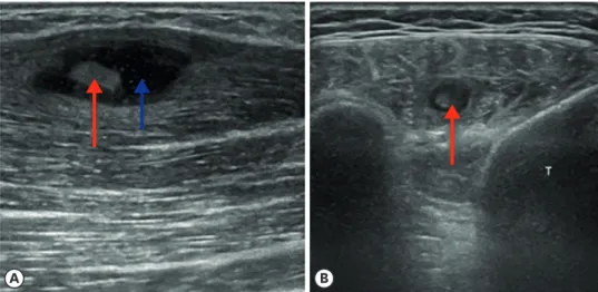 Fig. 3. Ultrasonography of the (A) right elbow and (B) right lower leg show echogenic nodular lesions (red arrow)  inside echogenic cystic lesions in the intramuscular space