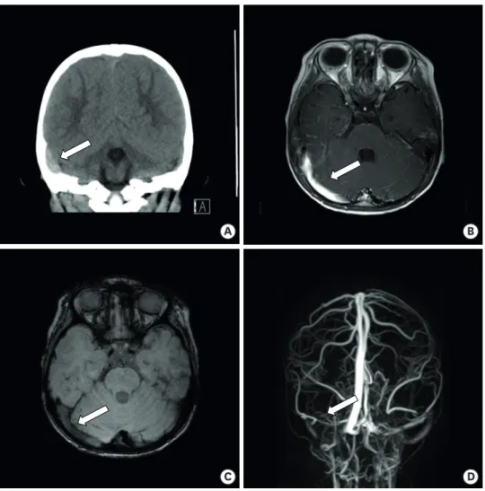 Fig. 1. Non-contrast-enhanced computed tomography performed on the 1st hospital day showed a high-density  lesion noted in right transverse-sigmoid sinus area (arrow) (A)