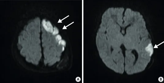 Fig. 1. Brain diffusion-weighted magnetic resonance imaging scan of 23-day-old baby at hospital day 2