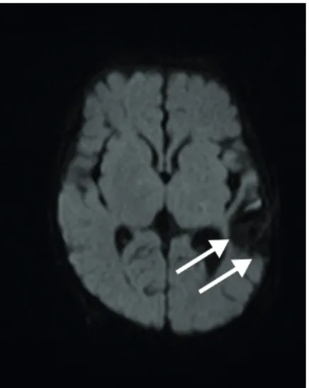 Fig. 2. Brain magnetic resonance diffusion scan at 3 months of age, 2 months after treatment