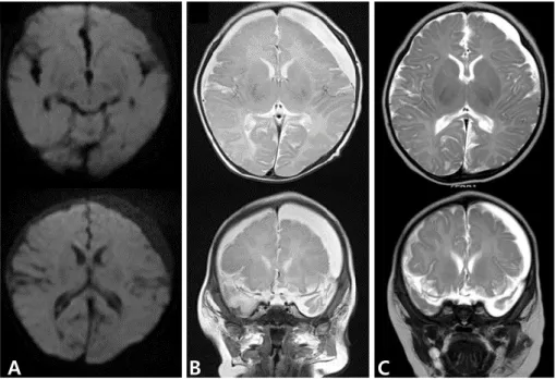 Fig. 2. (A) Magnetic resonance image (MRI) on the 24th hospital day showed no more  diffusion restriction, (B) but increased in amount of extra-axial fluid collection at left  cerebral convexity