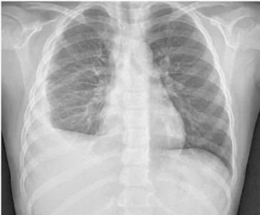 Fig. 1. Chest radiography shows right pleural effusion.