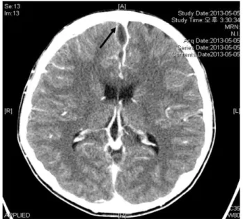 Fig. 1. Waters' view demonstrating right acute  maxillary sinusitis  &amp;  frontal  sinusitis  with  an  air-fluid  level.