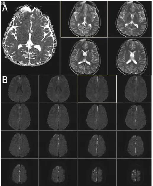 Fig. 3. T1 &amp; T2 weighted contrast cerebral MRI showed a thin layer of subdural  collection  along  falx  and  interhemispheric  fissure  with  restricted  diffusion  (typical finding  of  subdural  empyema)
