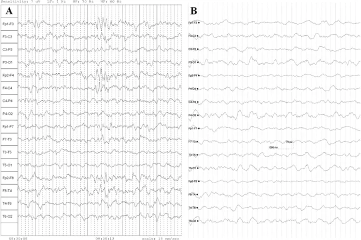 Fig.  1.  (A)  The  initial  electroencephalography  shows  regular  and  symmetric  background  activity  of  1-3  Hz,  with  intermittent sharp high-amplitude waves in both frontal areas