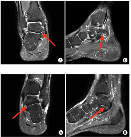 Figure 1. Coronal (A) and sagittal (B) T2  image of the cartilagenous talocalcaneal  coalition