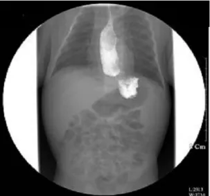Fig. 2. The image shows scattered whitish ulcerations and hemorrhages in the mid esophagus.