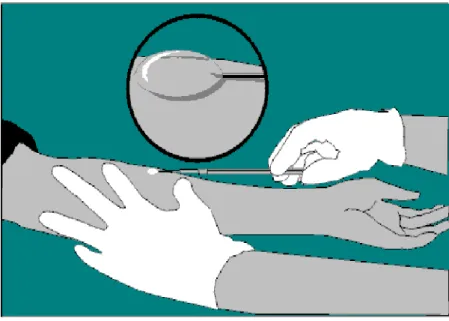 Fig. 2. Interpretation of tuberculin skin test by the ball- ball-point pen method.