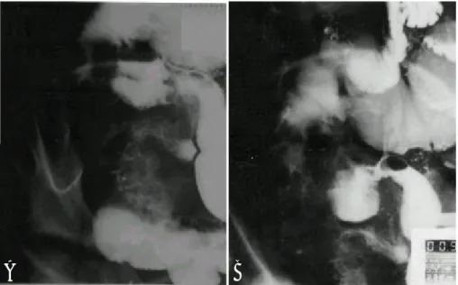Fig. 1. Barium enema at the time of diagnosis. Marked narrowing of lumen in cecum and distal ascending colon with mucosal irregularity