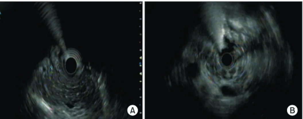 Fig. 2. Endoscopic ultrasonography findings of the patients. Hyperechoic strands (A), lobularity (B).