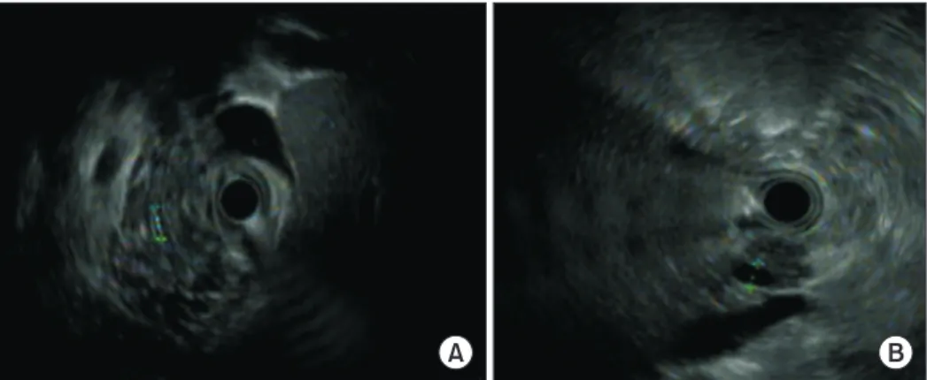 Fig. 3. Endoscopic ultrasonography findings of the patients. Hyperechoic duct wall (A) and dilatation of the main  pancreatic duct (B).