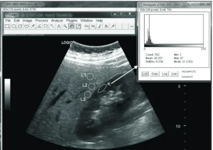 Fig. 2. Histogram analysis of the liver/right kidney ultrasonographic image obtained in the sagittal plane of the  right upper-quadrant of the body, using ImageJ software