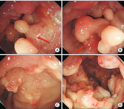 Fig. 1. Colonoscopy showing multiple numerous sessile and pedunculated (arrow) polyps (A, B) covered with  diffuse fibrinous exudative materials in the rectum