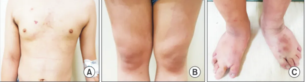 Fig. 2. Diffuse, irregular, marginated, light-red capillary malformations on the trunk (A) and lateral aspect of the  lower extremities (B), which are characteristic findings in Klippel-Trenaunay syndrome called port-wine stains