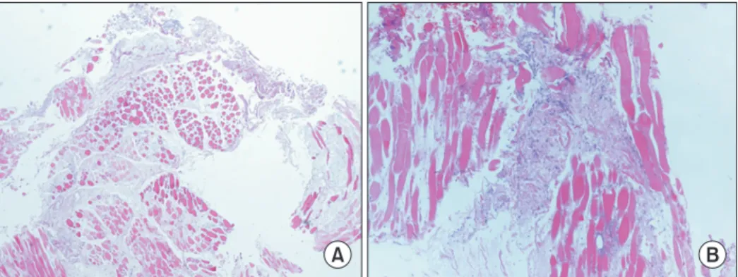 Fig. 2. Microscopic findings of masseter muscle biopsy. (A) Significant size variation, degeneration, and atrophy  of muscle fibers are identified